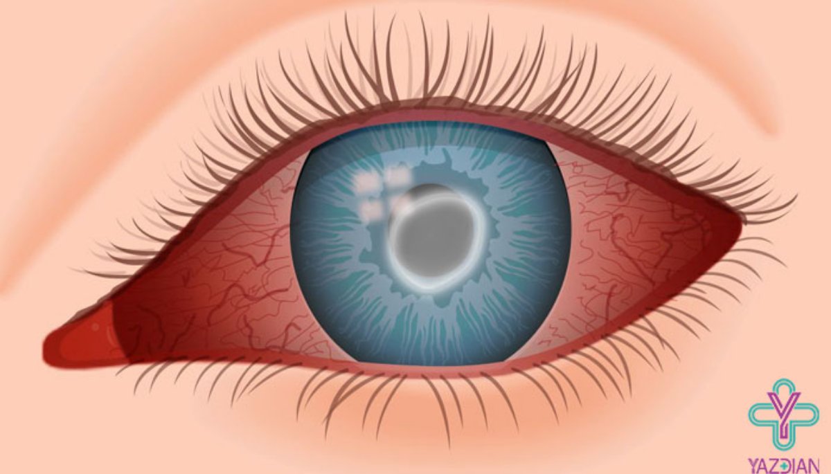 عفونت چشم چیست؟ و راه های درمان 